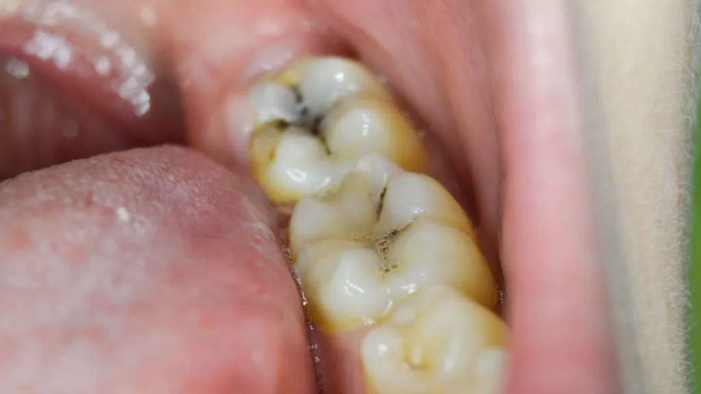 Avinashi Multispecialty Dental Cinic - Latest update - Tooth Decay