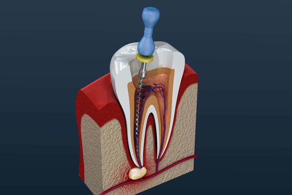 Avinashi Multispecialty Dental Cinic - Endodontics (Root Canal treatment)