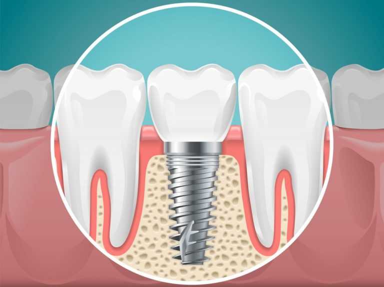 Avinashi Multispecialty Dental Cinic - Service - Implant Dentistry