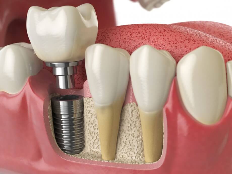 Avinashi Multispecialty Dental Cinic - Latest update - Dental Implants In BTM Layout