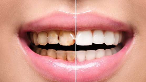 Avinashi Multispecialty Dental Cinic - Latest update - Teeth Whitening Services In Begur