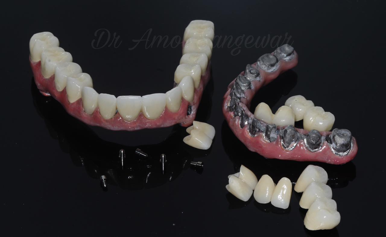 Avinashi Multispecialty Dental Cinic - Album - Full Mouth Implant Rehabilitation