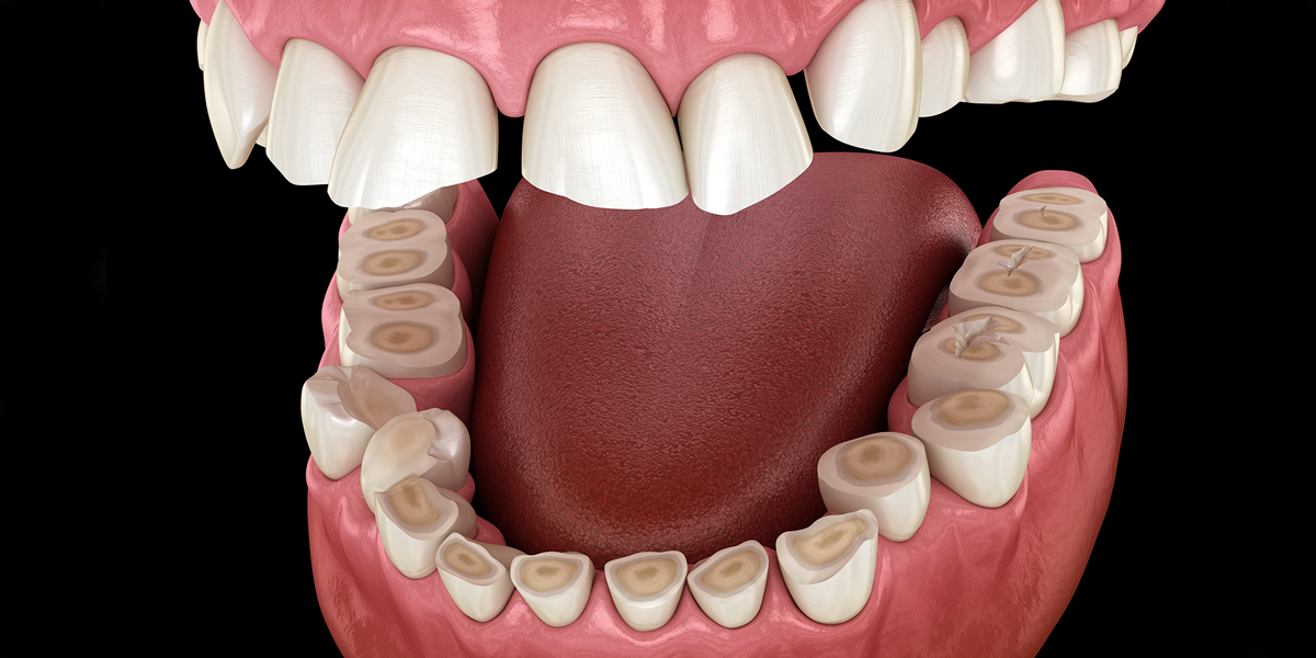 Avinashi Multispecialty Dental Cinic - Latest update - Teeth Grinding