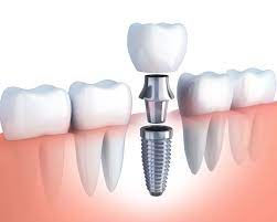 Avinashi Multispecialty Dental Cinic - Latest update - Tooth Implants Treatment