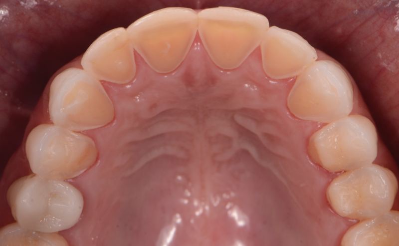 Avinashi Multispecialty Dental Cinic - Latest update - Dental Erosion