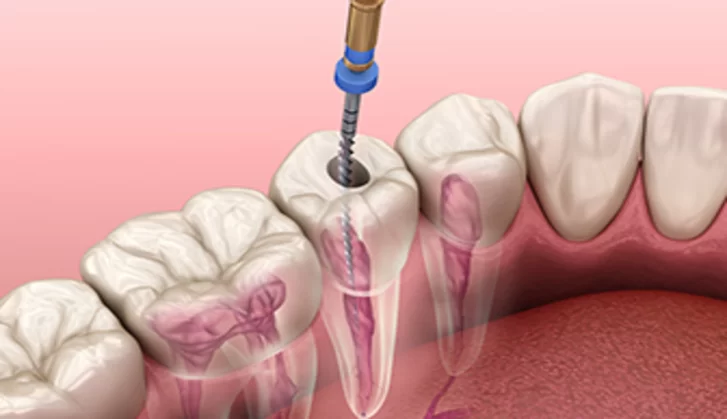 Avinashi Multispecialty Dental Cinic - Latest update - Endodontics (Root Canal Treatment) In Bangalore