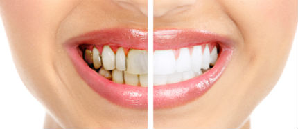 Avinashi Multispecialty Dental Cinic - Latest update - Teeth Whitening Services In Bilekahalli