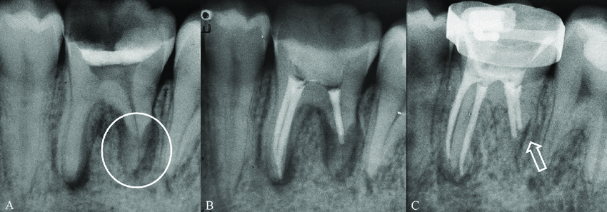 Avinashi Multispecialty Dental Cinic - Latest update - Periapical