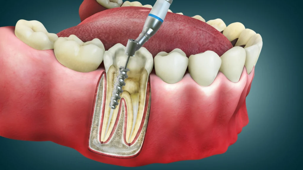 Avinashi Multispecialty Dental Cinic - Latest update - Root Canal Specialist Near BTM Layout