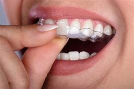 Avinashi Multispecialty Dental Cinic - Latest update - BRACES AND ALIGNERS SERVICES IN BOMMANAHALLI