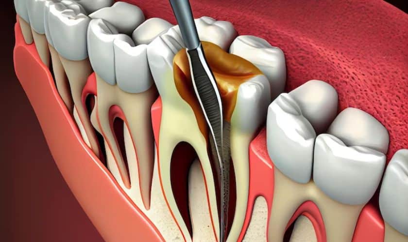 Avinashi Multispecialty Dental Cinic - Latest update - Root Canal Specialist Near Me