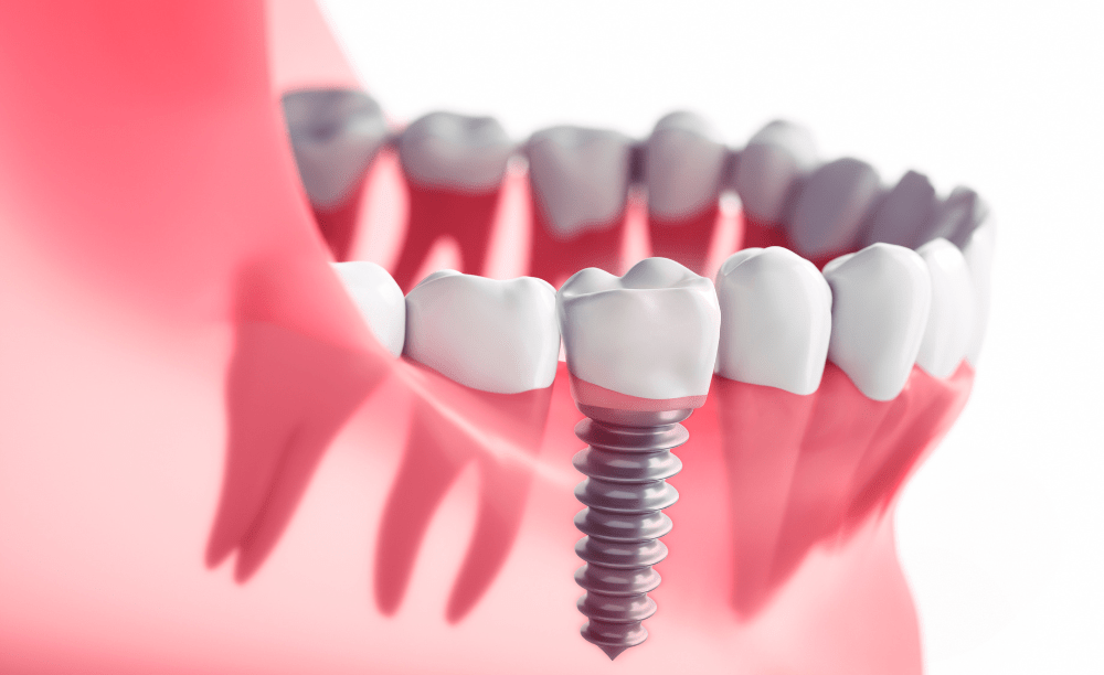 Avinashi Multispecialty Dental Cinic - Latest update - Implant Dentistry near me