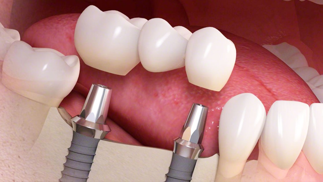 Avinashi Multispecialty Dental Cinic - Latest update - Crowns And Bridges Treatment in Silk Board