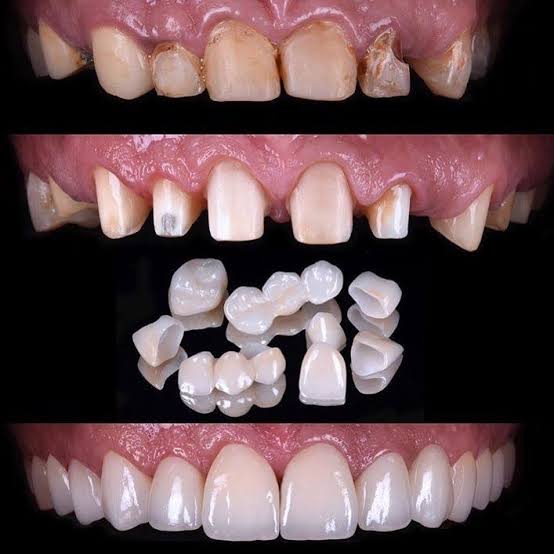 Avinashi Multispecialty Dental Cinic - Full mouth Rehabilitation