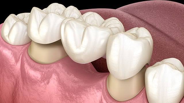 Avinashi Multispecialty Dental Cinic - Crowns And Bridges