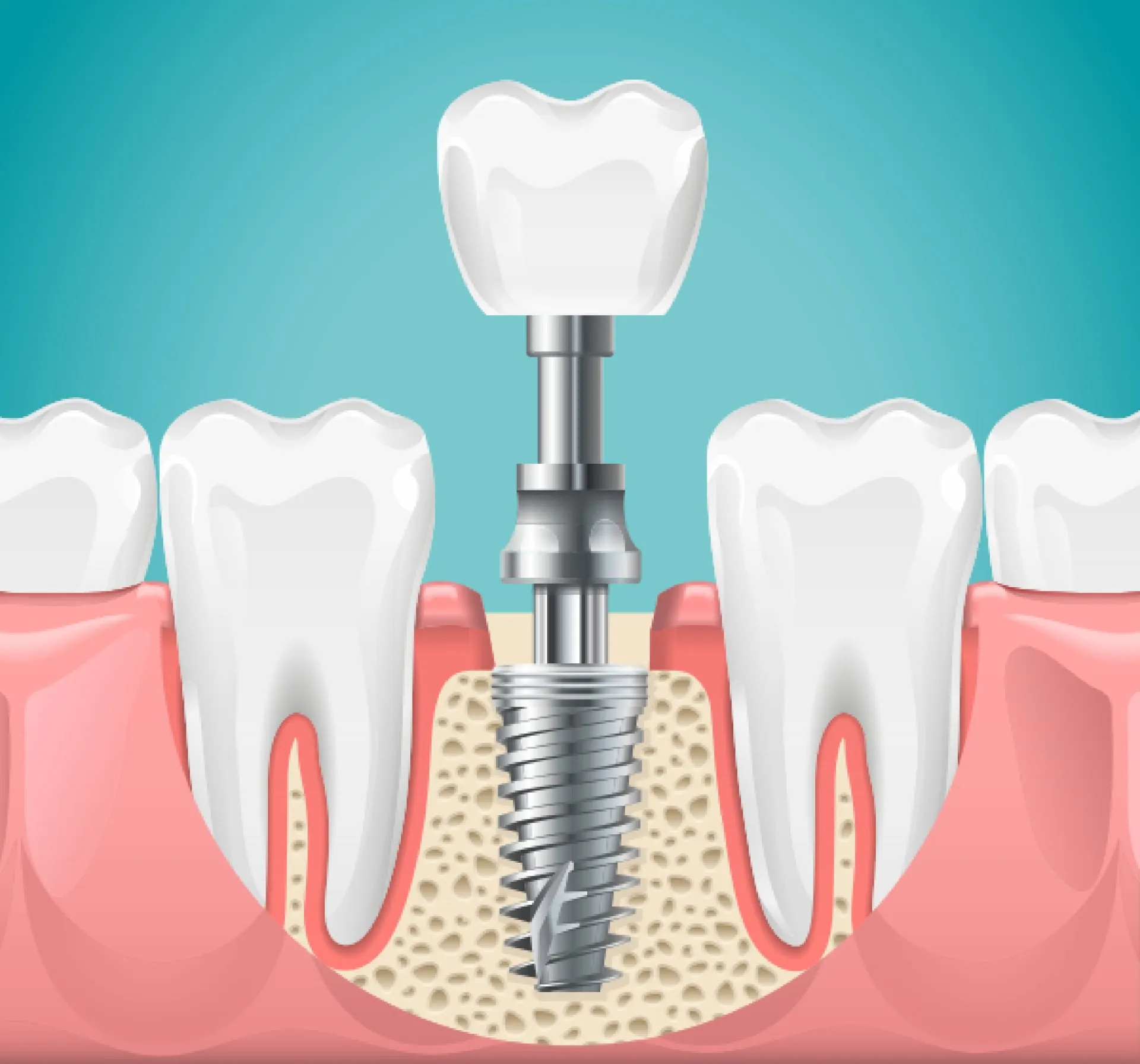 Avinashi Multispecialty Dental Cinic - Latest update - Dental Implant