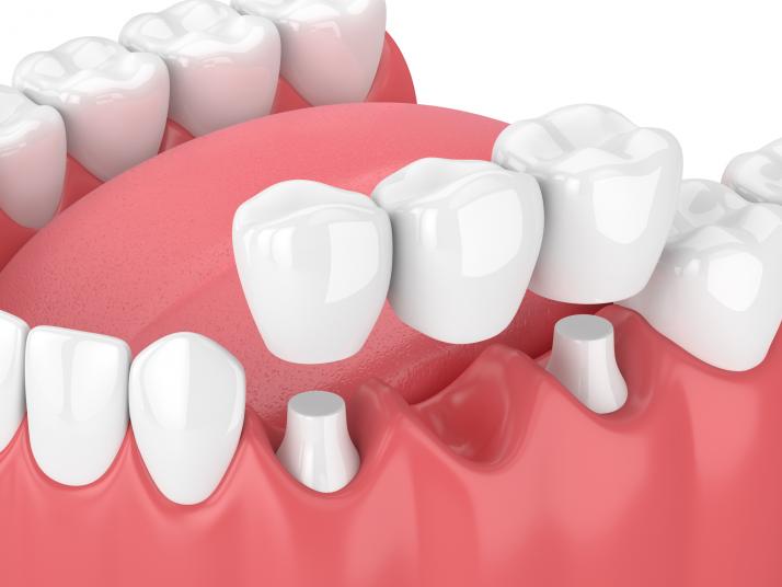 Avinashi Multispecialty Dental Cinic - Latest update - Crowns And Bridges Treatment In Vijaya Bank Layout