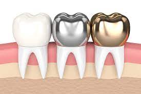 Avinashi Multispecialty Dental Cinic - Latest update - Receding Gums