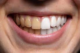 Avinashi Multispecialty Dental Cinic - Latest update - Teeth Whitening Services In Bilekahalli