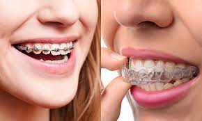 Avinashi Multispecialty Dental Cinic - Latest update - BRACES AND ALIGNERS