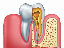 Avinashi Multispecialty Dental Cinic - Latest update - Cracked or Broken Teeth