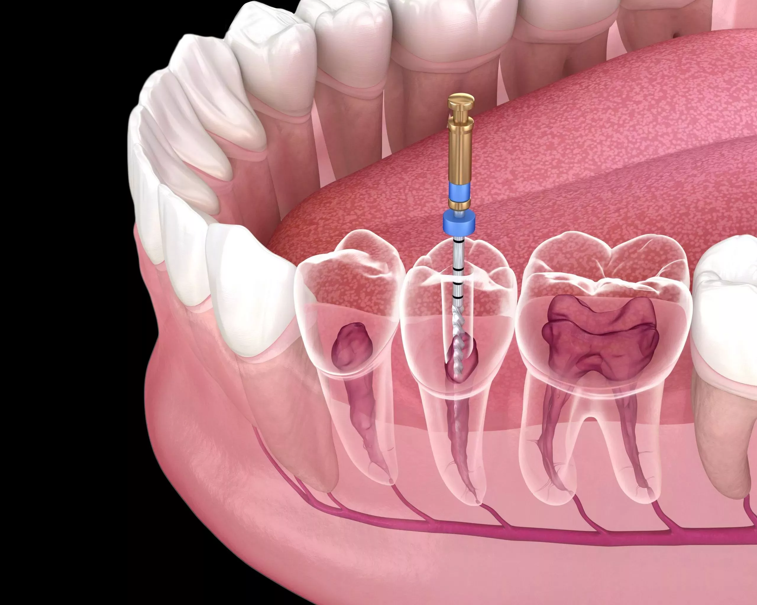 Avinashi Multispecialty Dental Cinic - Latest update - Endodontics (Root Canal Treatment) in Bilekahalli