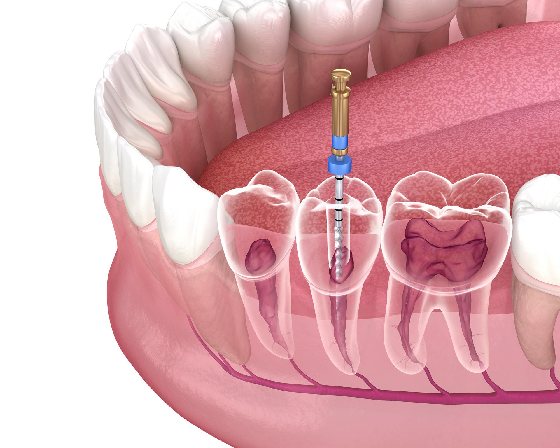 Avinashi Multispecialty Dental Cinic - Latest update - Endodontics Treatment In BTM Layout