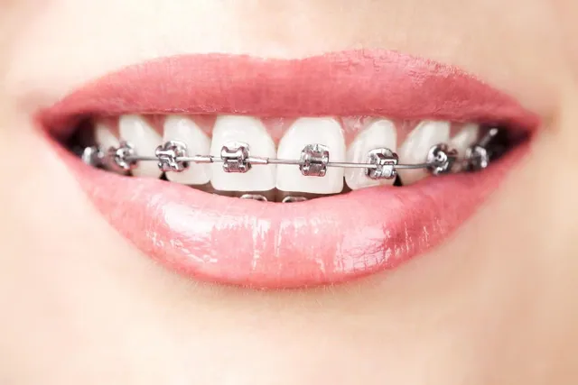 Avinashi Multispecialty Dental Cinic - Latest update - BRACES AND ALIGNERS