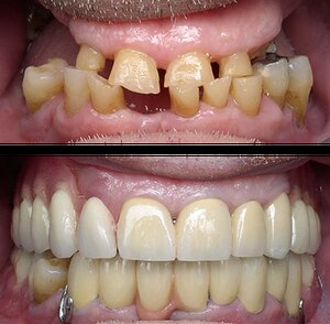 Avinashi Multispecialty Dental Cinic - Latest update - Full Mouth Rehabilitation Treatment In BTM Layout