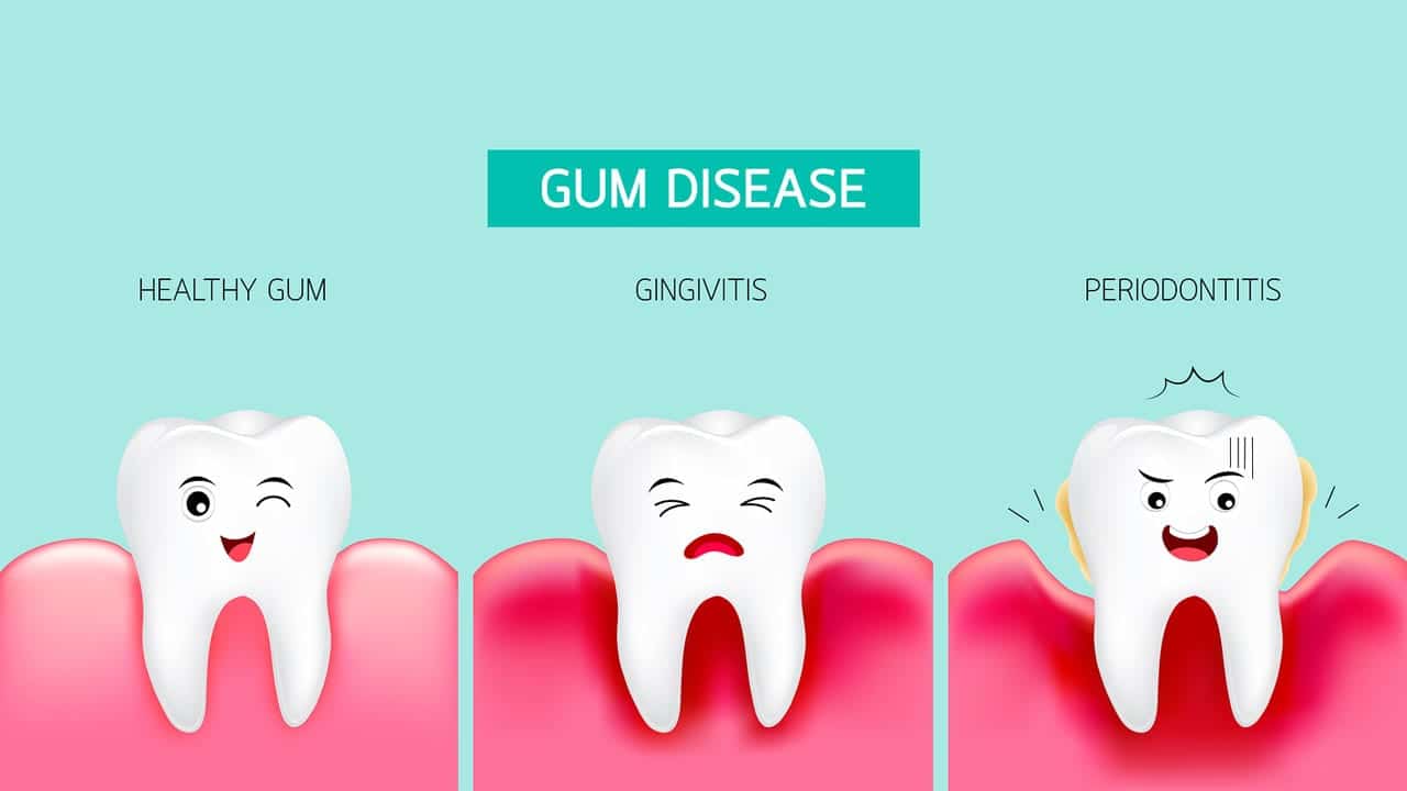 Avinashi Multispecialty Dental Cinic - Latest update - Gum Disease Treatment in BTM Layout