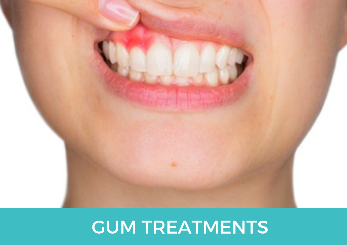 Avinashi Multispecialty Dental Cinic - Latest update - Gum Treatment Services In BTM Layout