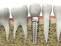 Avinashi Multispecialty Dental Cinic - Latest update - Implant Dentistry In Vijaya Bank Layout