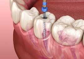 Avinashi Multispecialty Dental Cinic - Latest update - Root Canal Specialist Near Vijaya Bank Layout