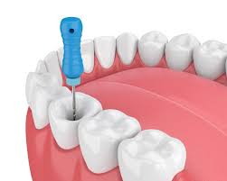 Avinashi Multispecialty Dental Cinic - Latest update - Endodontics Treatment In Vijaya Bank Layout