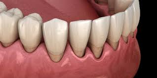 Avinashi Multispecialty Dental Cinic - Latest update - Bleeding Or Swollen Gums