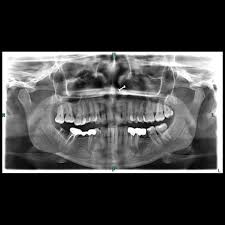 Avinashi Multispecialty Dental Cinic - Latest update - Periapical Cyst