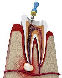 Avinashi Multispecialty Dental Cinic - Latest update - Endodontics (Root Canal Treatment) In Bangalore