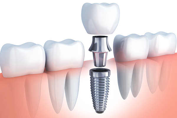 Avinashi Multispecialty Dental Cinic - Latest update - Implant Dentistry In BTM Layout