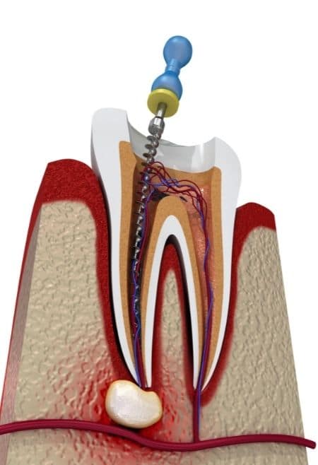 Avinashi Multispecialty Dental Cinic - Latest update - Root Canal Specialist Near Me