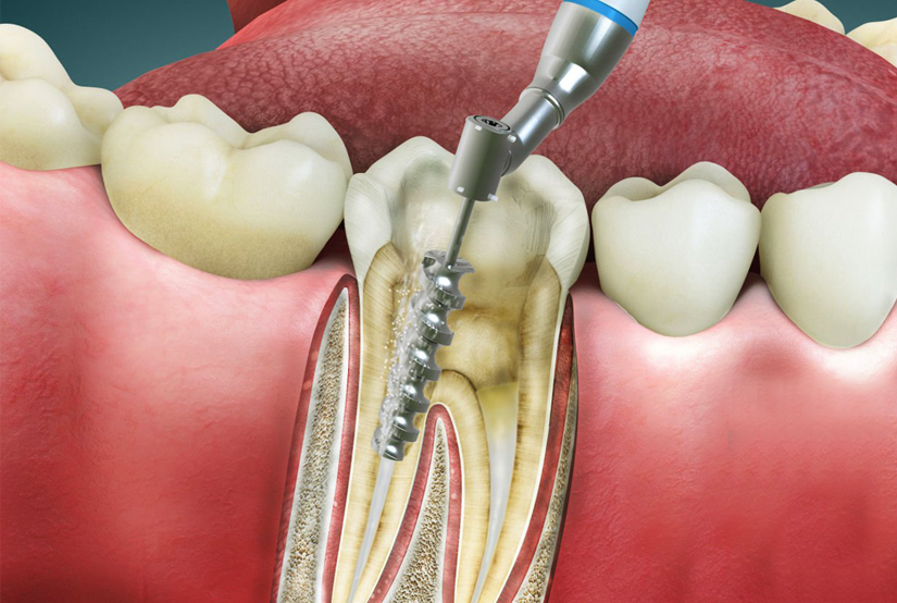 Avinashi Multispecialty Dental Cinic - Latest update - Root Canal Treatment in Bilekahalli