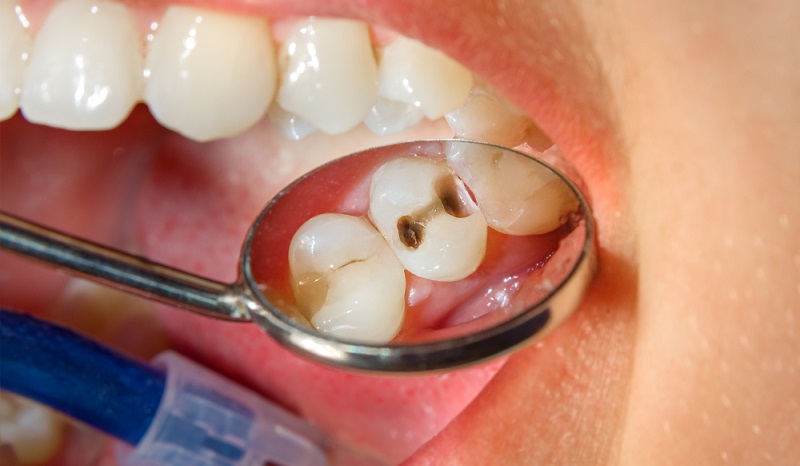 Avinashi Multispecialty Dental Cinic - Latest update - Treatment For Tooth Decay Near BTM lLayout