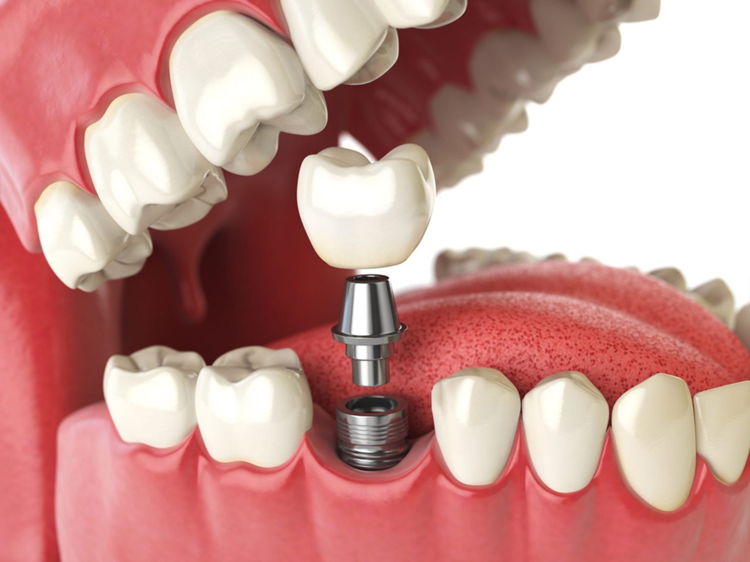 Avinashi Multispecialty Dental Cinic - Latest update - Implant Dentistry Center In HSR Layout